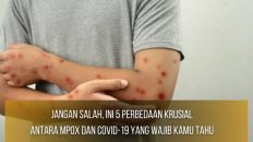 Perbedaan Krusial Antara Mpox dan COVID-19