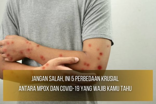 Perbedaan Krusial Antara Mpox dan COVID-19 Perbedaan Krusial Antara Mpox dan COVID-19